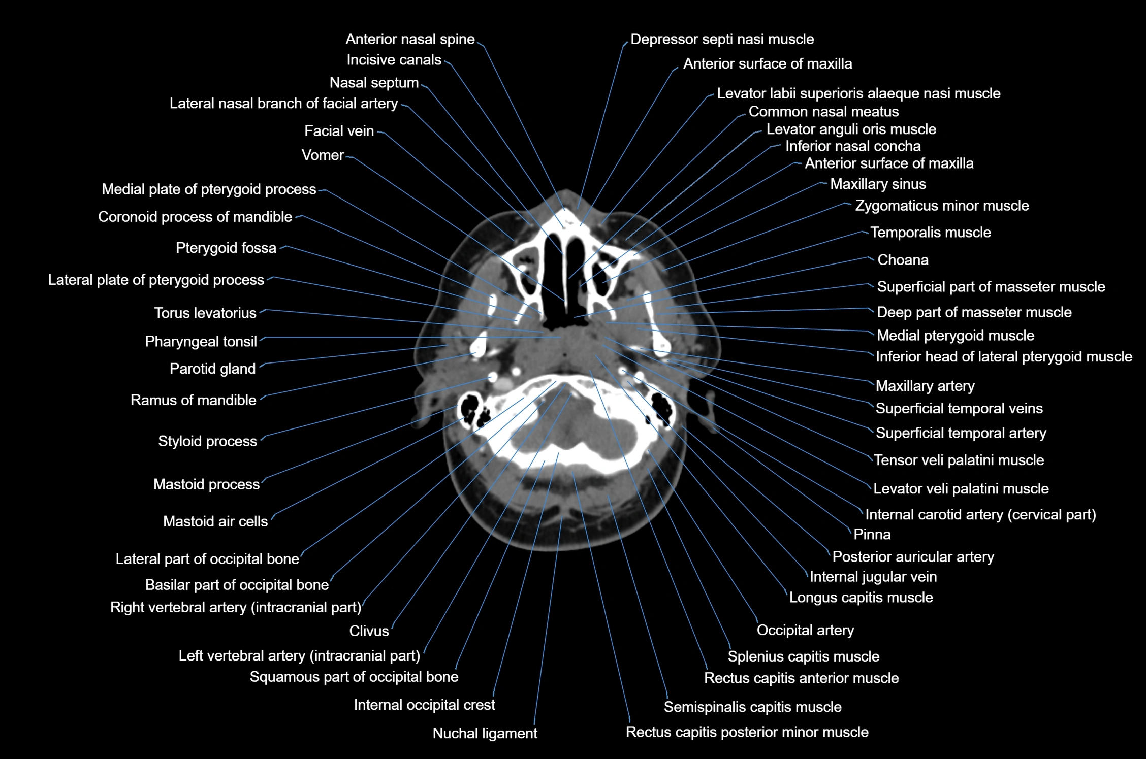 CT Neck axial cross sectional anatomy radiology image-img-00001-00019.webp